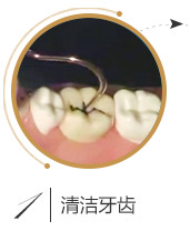 儿童口腔窝沟封闭流程一