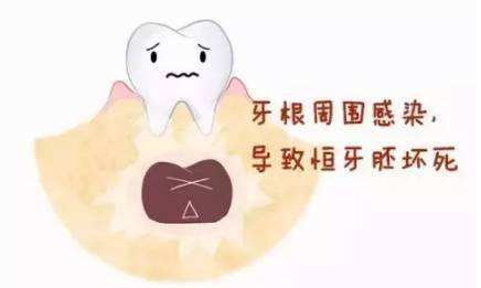 龋齿