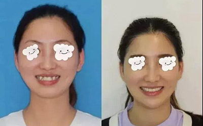 听说冬天矫牙减肥快？是真的吗？(图1)