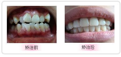 牙齿矫正的几大误区(图1)